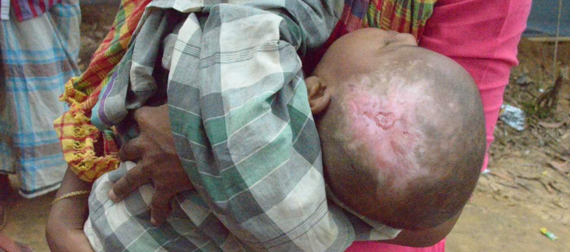 Krankes Baby aus Myanmar in Bangladesch