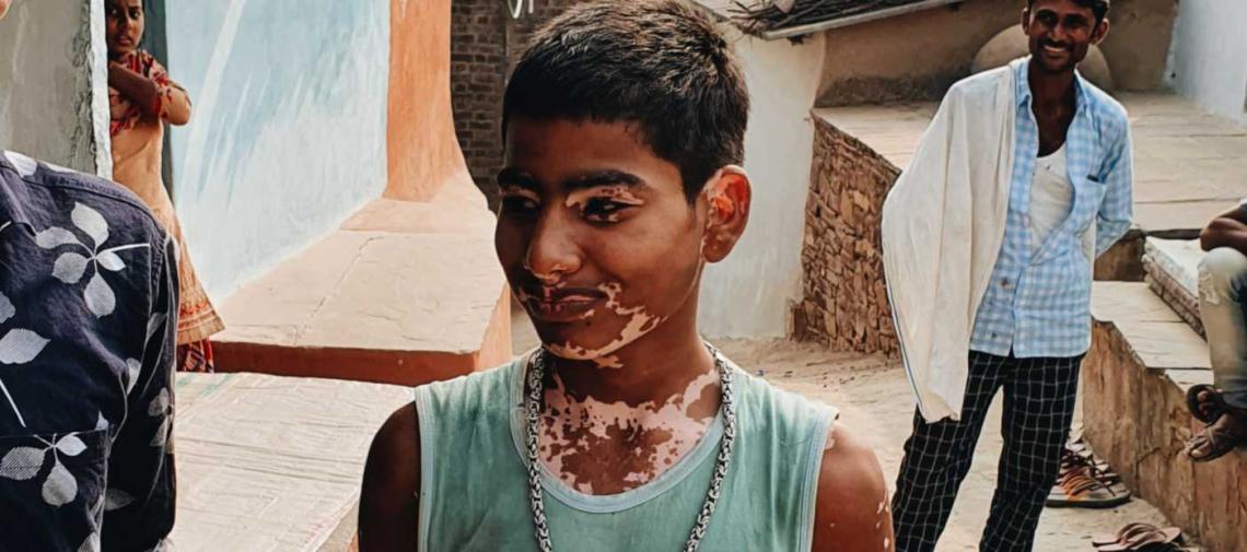 Patenkind mit einer Hautkrankheit