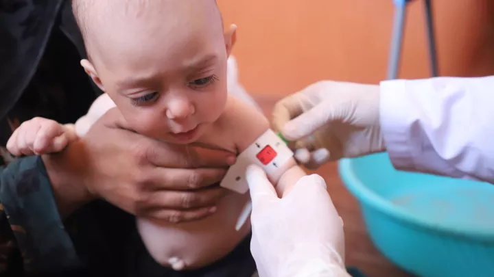 Unterernährtes Kind in Afghanistan