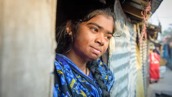Mädchen aus Bangladesch mit Narben durch Verbrennungen, die während ihrer Arbeit entstanden.